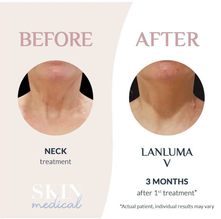 Wrinkle relaxing - Neck smoothing