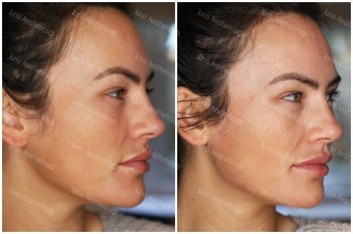 Hyaluronic Acid Dermal Filler - Jawline & chin (3ml)