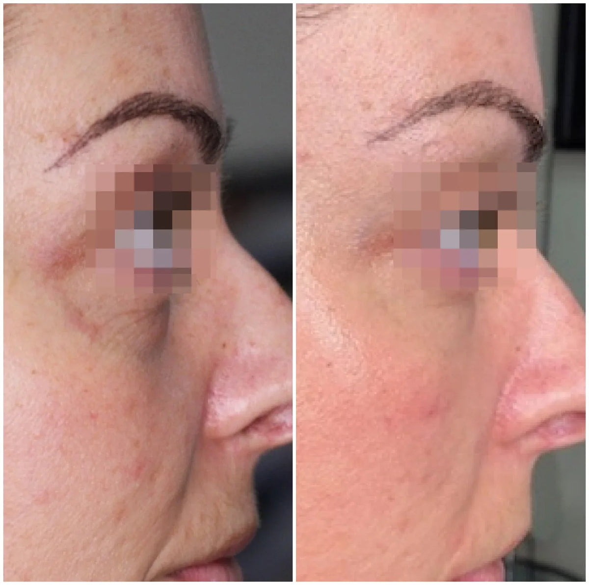 Hyaluronic Acid Dermal Filler - Tear Trough Under Eye (1ml)
