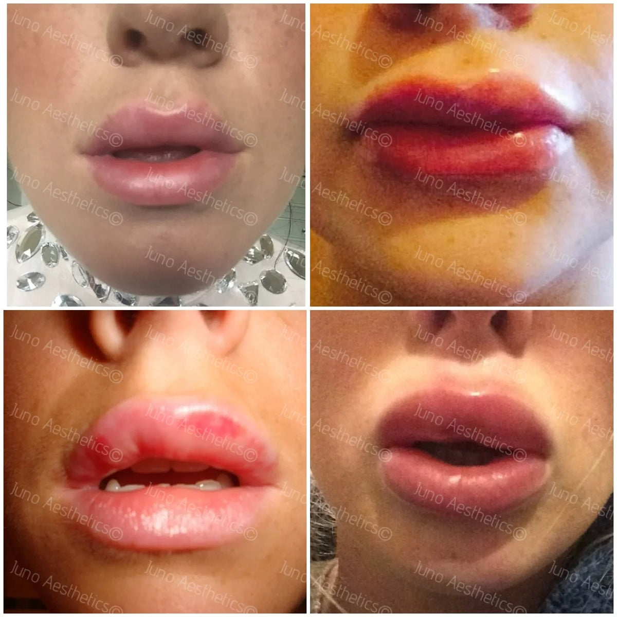 Getting ready for your lip filler and possible complications