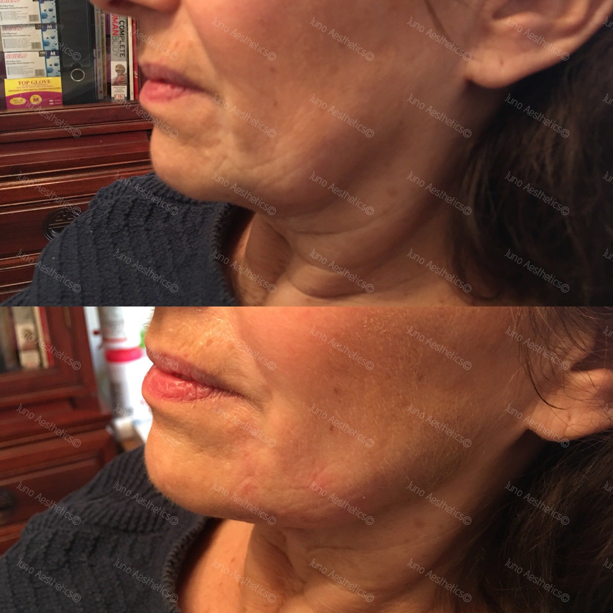 Hyaluronic Acid Dermal Filler - Chin (1ml)