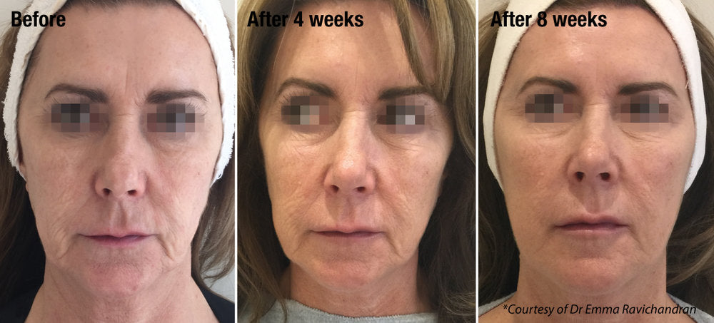 Injectable skin treatment - Profhilo Structura (2ml)