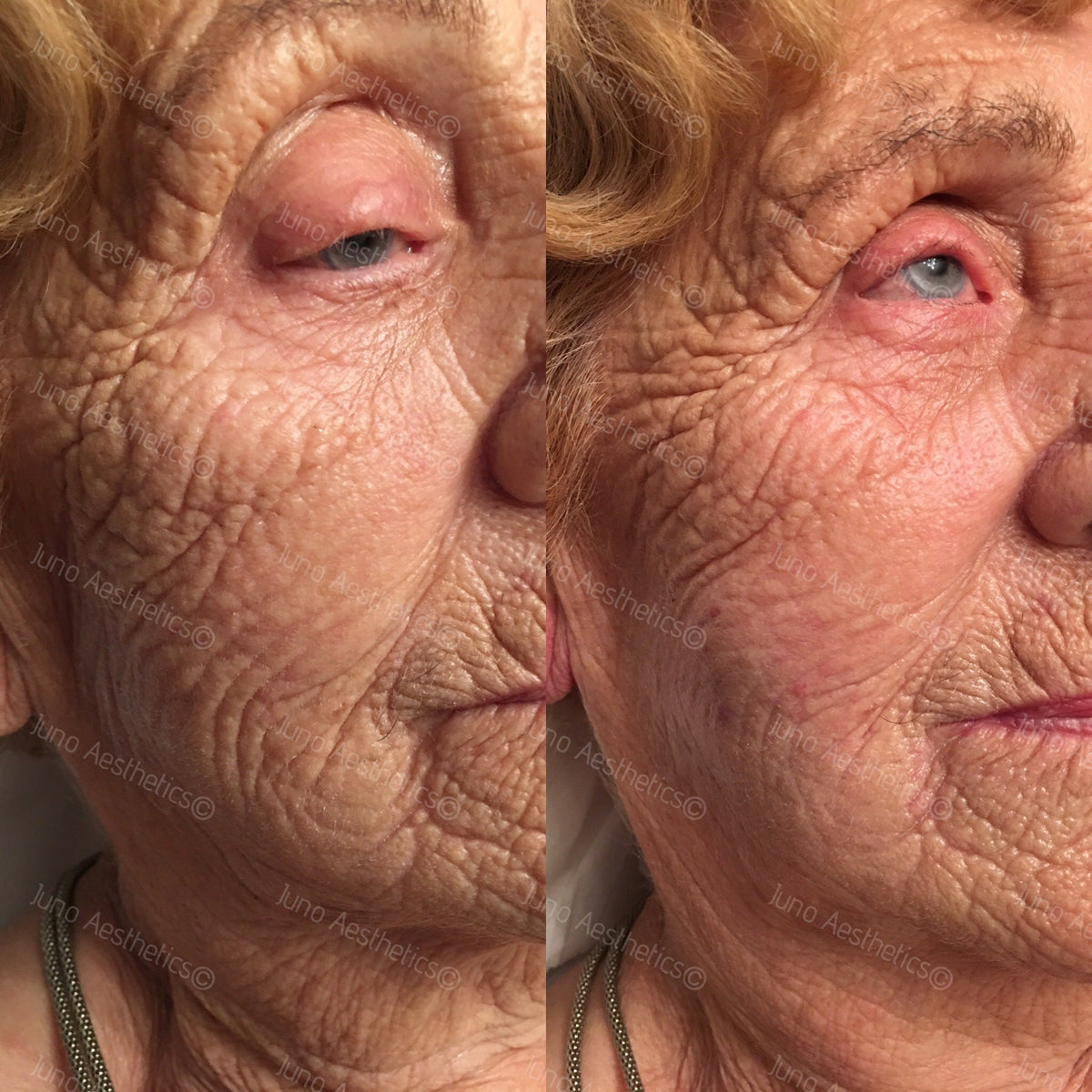 Injectable skin treatment - Restylane Skinboosters (1ml)