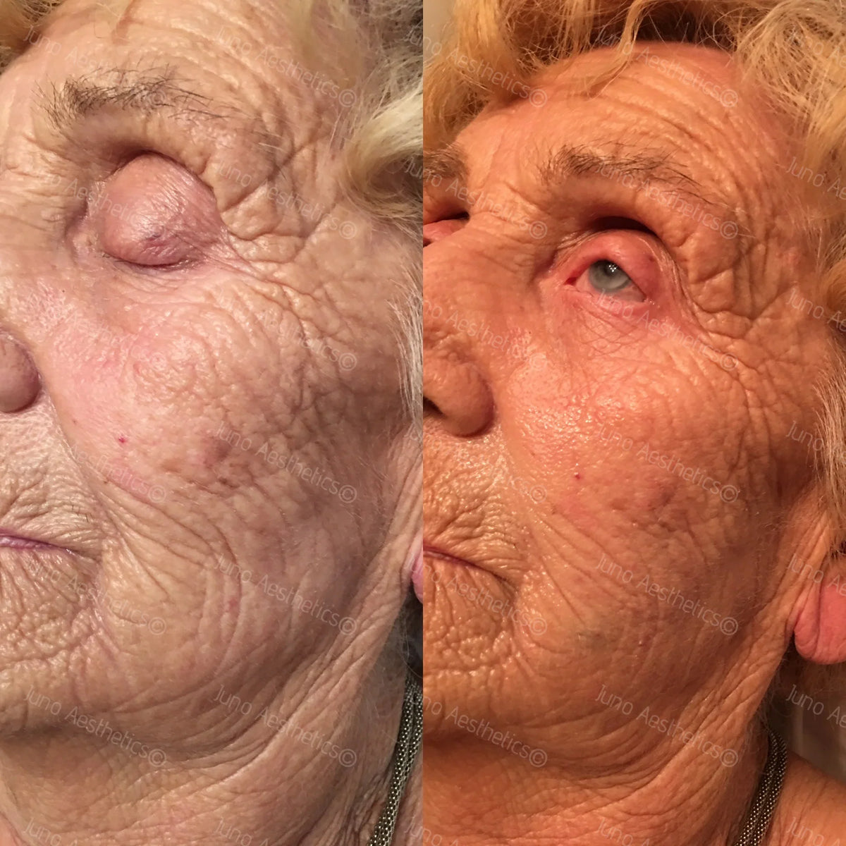 Injectable skin treatment - Restylane Skinboosters (1ml)