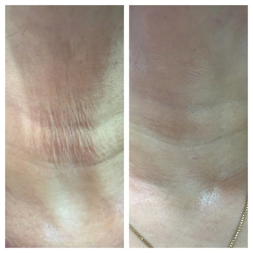 Hyaluronic Acid Dermal Filler - Neck (2ml)