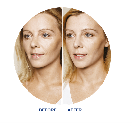 Injectable skin treatment - Restylane Skinboosters (1ml)