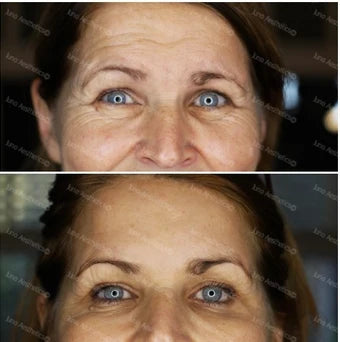 Wrinkle relaxing - 3 areas (potent)