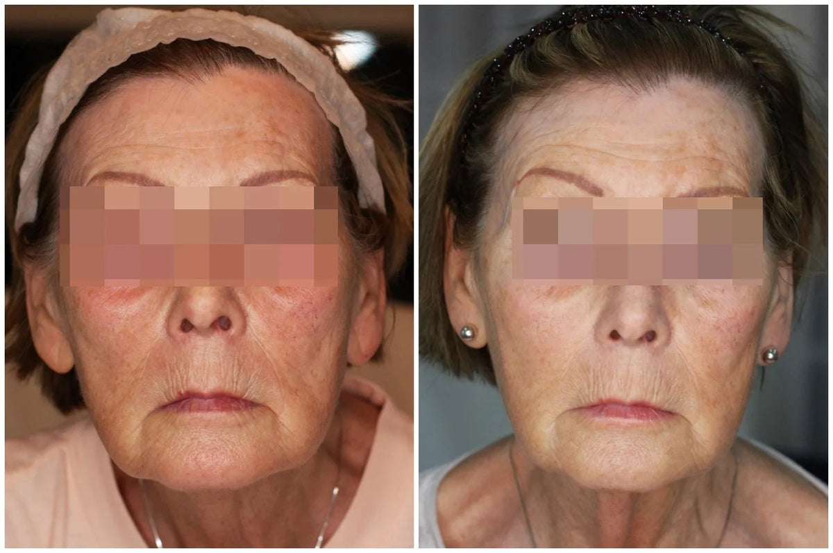 Hyaluronic Acid Dermal Filler - Whole face rejuvenation (4ml)