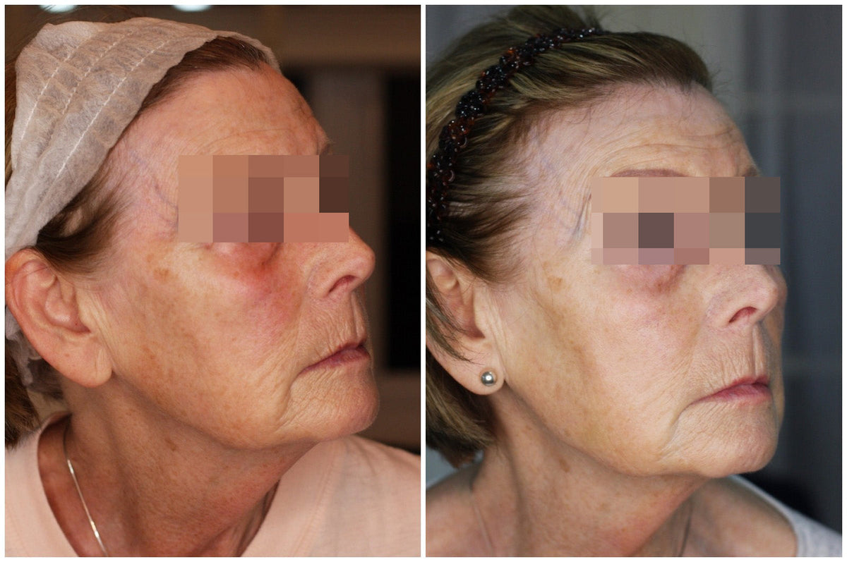 Hyaluronic Acid Dermal Filler - Whole face rejuvenation (4ml)
