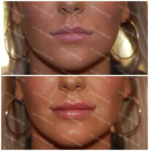 Hyaluronic Acid Dermal Filler - Natural lip volume (1ml)
