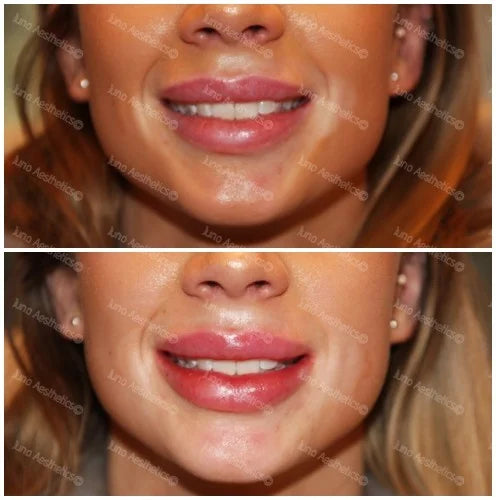 Hyaluronic Acid Dermal Filler - Lip refresh (0.7ml)