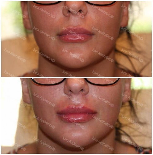 Hyaluronic Acid Dermal Filler - Very volumised lip volume (1.5ml)