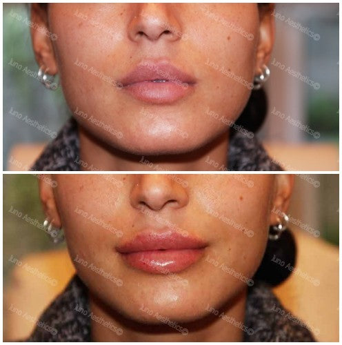 Hyaluronic Acid Dermal Filler - Natural lip volume (1ml)