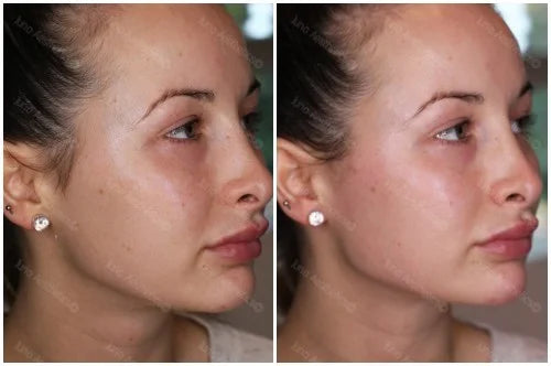 Hyaluronic Acid Dermal Filler - Chin (1ml)