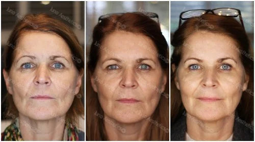 Injectable skin treatment - Profhilo 3ml
