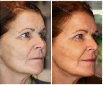 Injectable skin treatment - Profhilo Structura (2ml)