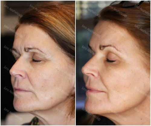 Injectable skin treatment - Profhilo 2ml