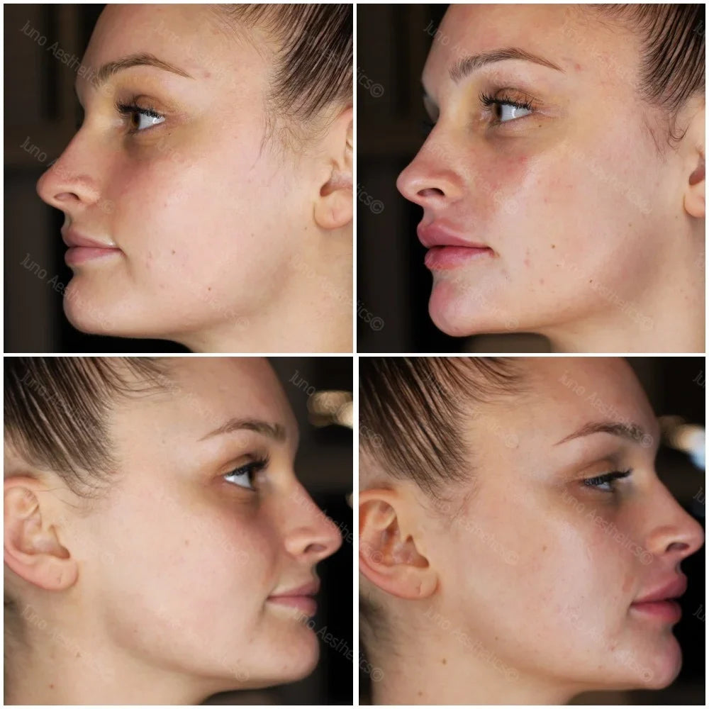 Topical skin treatments - Medium depth chemical peel