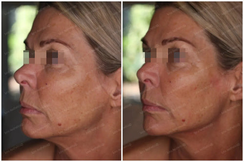 Hyaluronic Acid Dermal Filler - Lower face refresh (2ml)