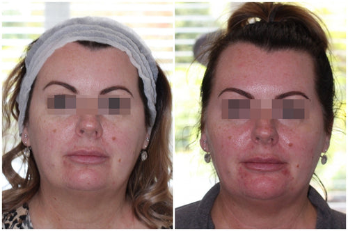Hyaluronic Acid Dermal Filler - Natural cheek volume (2ml)