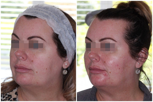 Hyaluronic Acid Dermal Filler - Natural cheek volume (2ml)