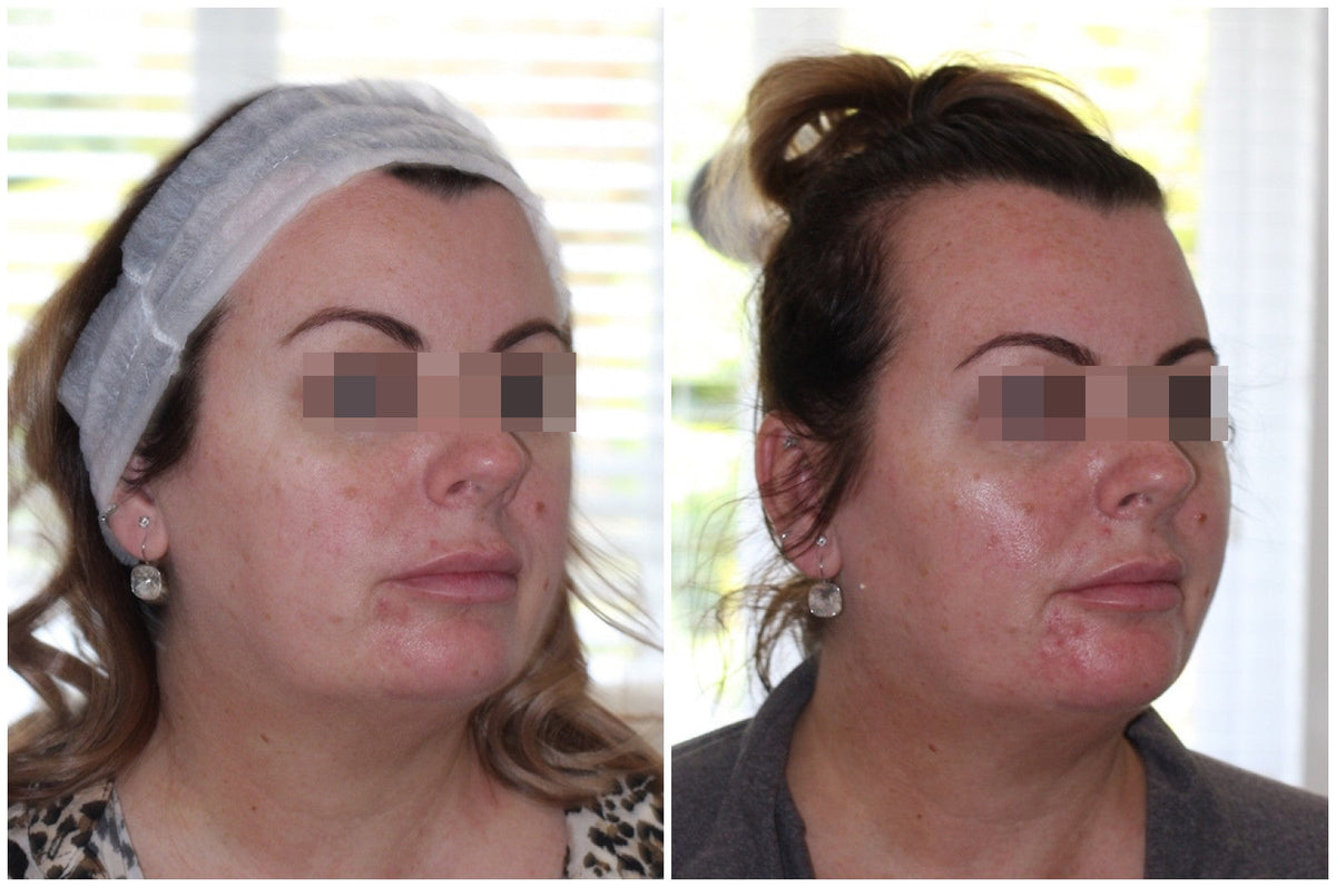 Hyaluronic Acid Dermal Filler - Natural cheek volume (2ml)