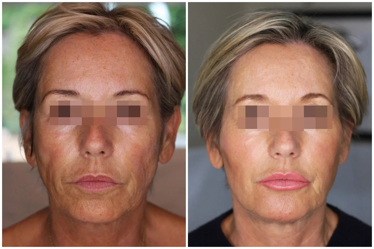Hyaluronic Acid Dermal Filler - Undetectable cheek volume (1ml)