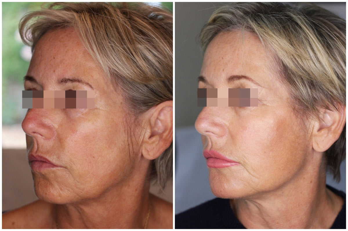 Hyaluronic Acid Dermal Filler - Whole face rejuvenation (3ml)