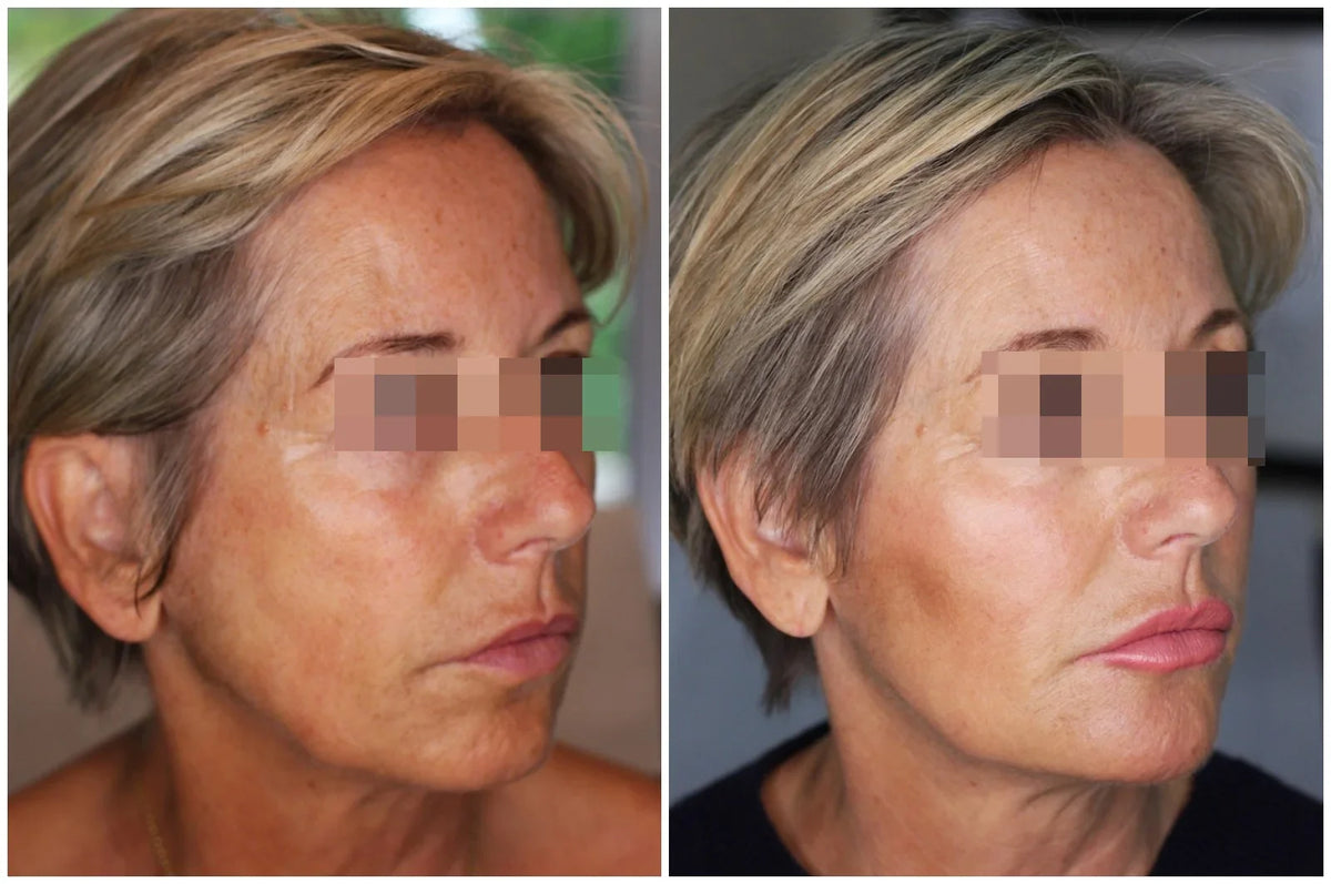Hyaluronic Acid Dermal Filler - Whole face rejuvenation (5ml)