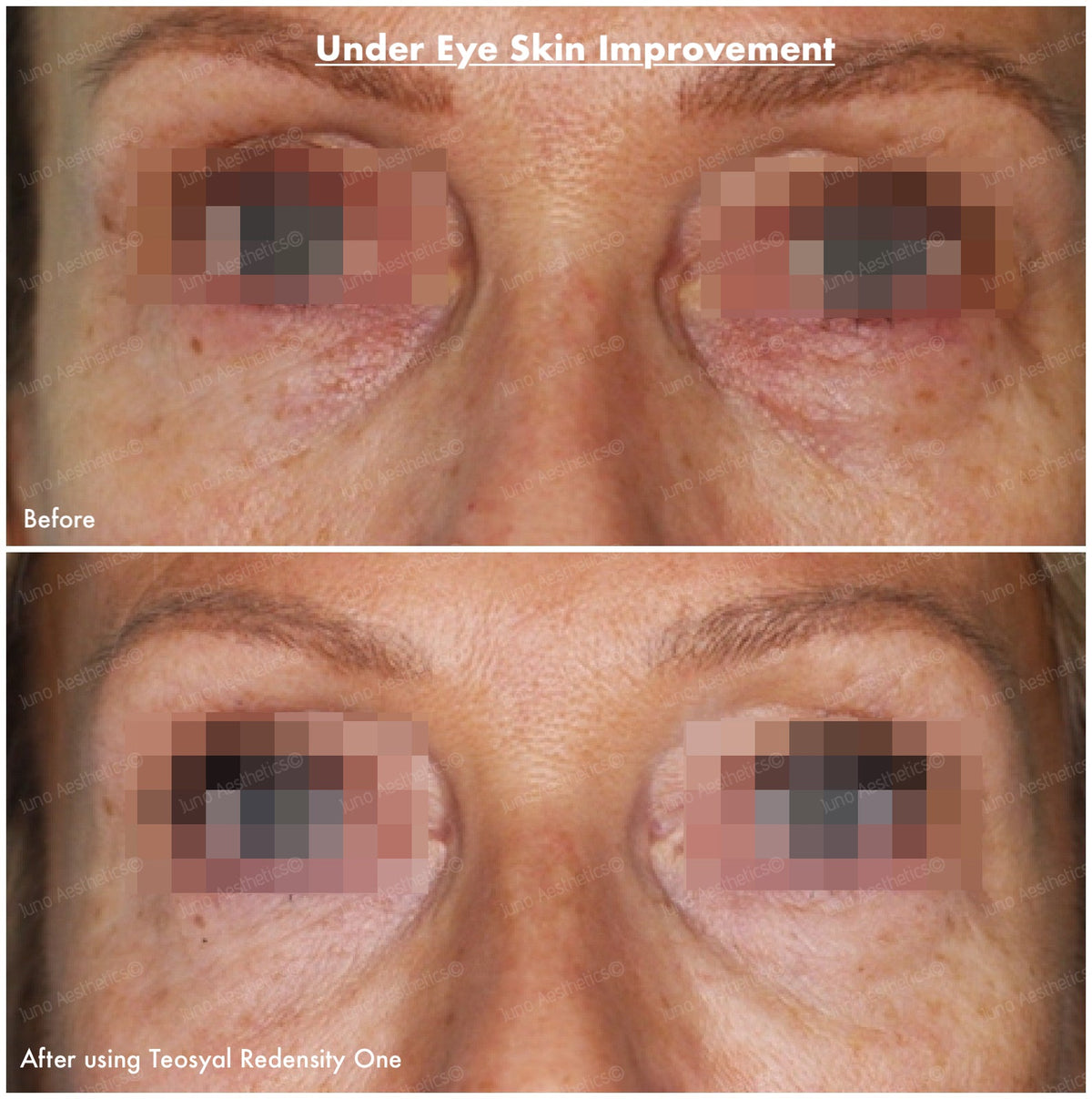 Hyaluronic Acid Dermal Filler - Tear Trough Under Eye (1ml)