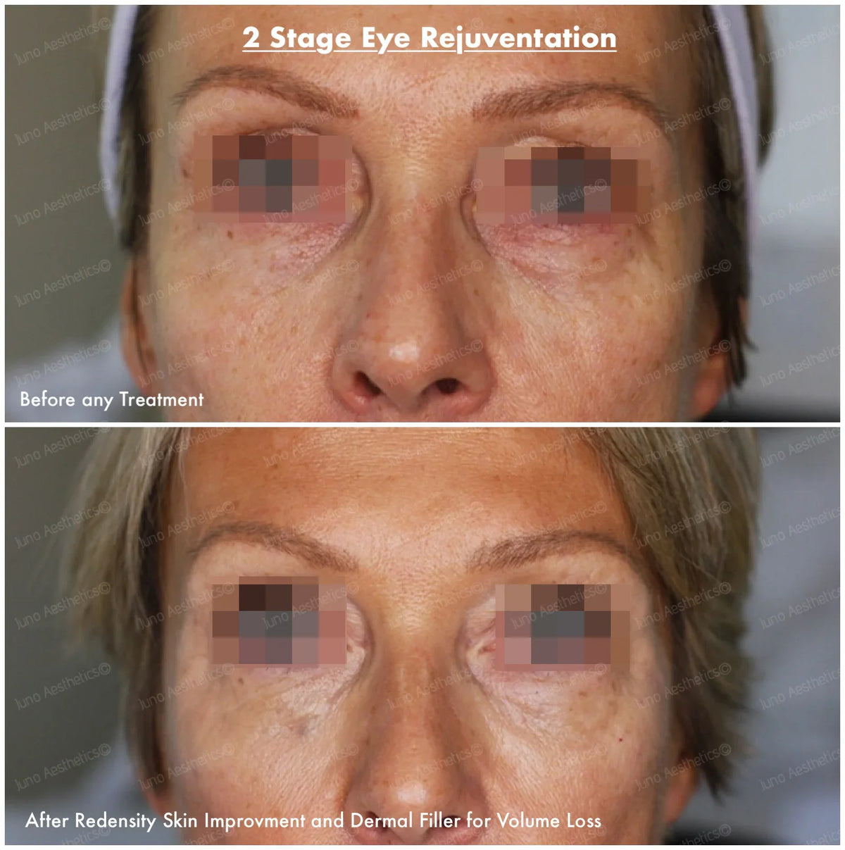 Hyaluronic Acid Dermal Filler - Tear Trough Under Eye (1ml)