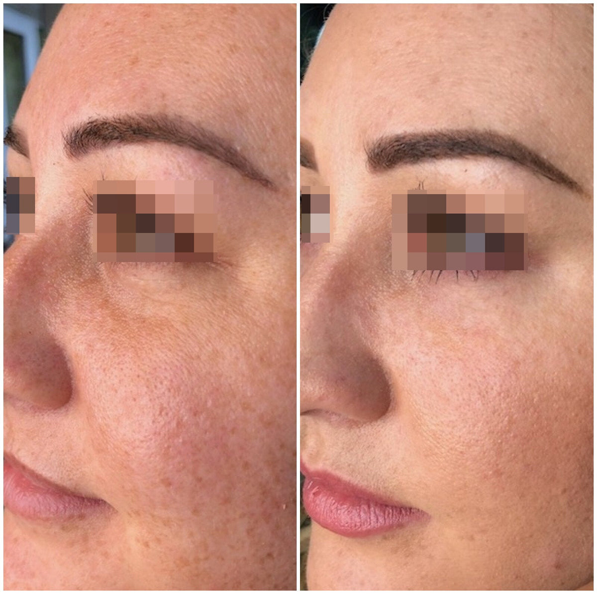 Hyaluronic Acid Dermal Filler - Tear Trough Under Eye (1ml)