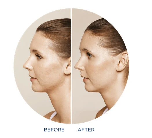 Injectable skin treatment - Restylane Skinboosters (1ml)